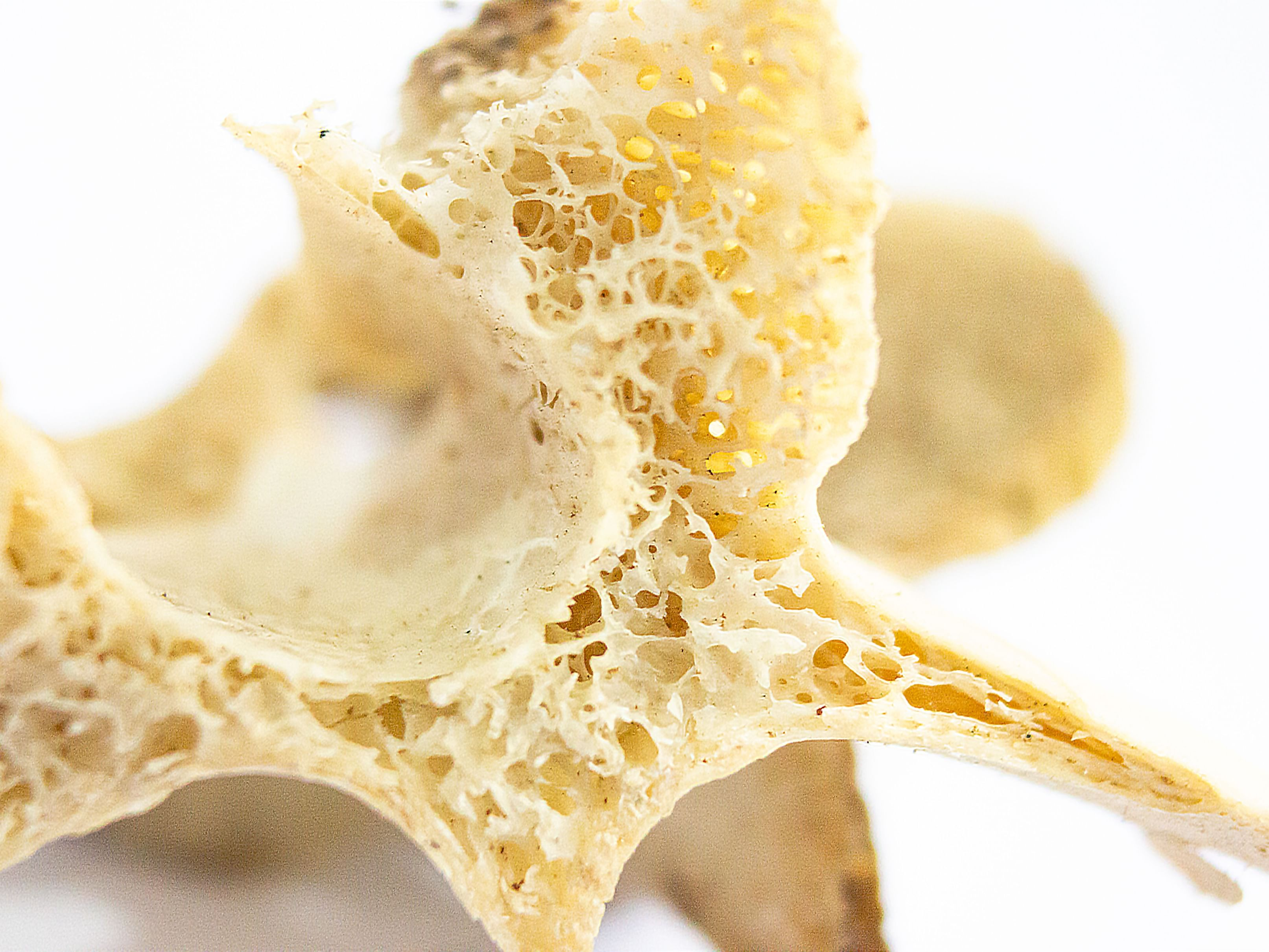 Study Links Lower Bone Density To Cognitive Decline